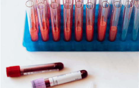 Diagnosis of High Cholesterol Levels in Costa del Sol