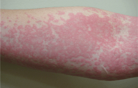 Tratamiento de Urticaria y Angioedema en Marbella