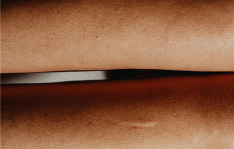 Revisión de cicatrices en Marbella