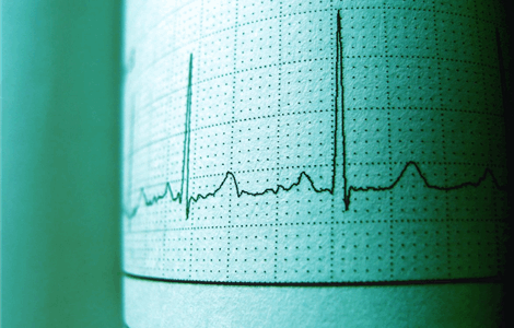 Diagnóstico de arritmias en la Costa del Sol