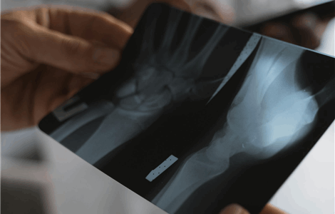 Home GP for Bone Fractures in Manilva