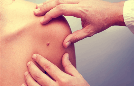 Mapeo de Lunares en Puerto Banús