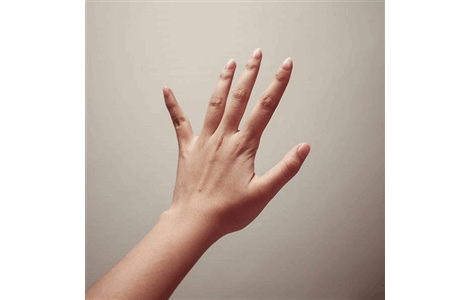 Tratamiento integral de la artritis psoriásica en Fuengirola